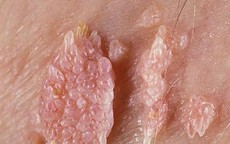Dấu hiệu nhận biết sớm bệnh sùi mào gà ở phụ nữ