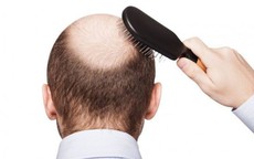 Rụng tóc ở nam giới là dấu hiệu bệnh gì?