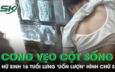 Tự ý ngừng đeo nẹp vì sợ bạn bè trêu chọc, nữ sinh 16 tuổi đối mặt nguy cơ mổ cột sống