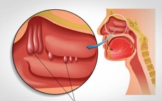 Nghẹt mũi, khó thở là biểu hiện của bệnh gì?