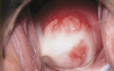 Những dấu hiệu cảnh báo nhiễm khuẩn Chlamydia gây nguy cơ vô sinh