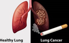 Thuốc lá gây ra 90% các trường hợp ung thư phổi
