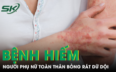 Căn bệnh hiếm khiến người phụ nữ sốt cao, toàn thân đỏ rực và bỏng rát dữ dội 