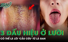 Đừng bỏ qua 3 dấu hiệu bất thường này trên lưỡi, có thể là lời 'cầu cứu' từ lá gan