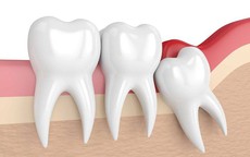 Răng số 8 mọc lệch không đau có cần nhổ?