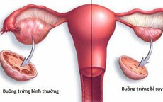 Vô kinh không đồng nghĩa với mãn kinh
