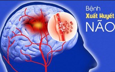 Cảnh báo xuất huyết não sau những cuộc nhậu kéo dài