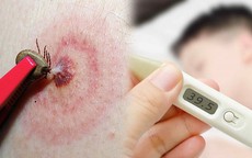 Suy đa tạng do mò đốt, đặc trưng của bệnh sốt mò cần biết