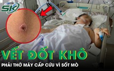 Người phụ nữ 49 tuổi lâm bạo bệnh, phải thở máy cấp cứu chỉ từ một vết đốt khô