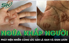 Ngứa khắp người nhiều tháng, bất ngờ phát hiện nhiễm cùng lúc sán lá gan và giun lươn 