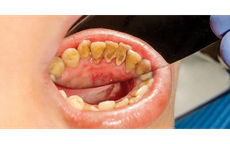 Có cần phải lấy cao răng thường xuyên?