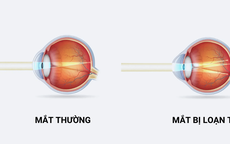 Trẻ bị loạn thị có cần đeo kính không?