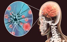 Viêm não tự miễn có nguy cơ tử vong cao nếu chẩn đoán muộn