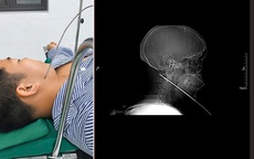 Nam thanh niên đi bắn cá bị mũi tên bật ngược đâm xuyên sâu 15cm vào vùng mặt