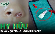 Răng mọc trong hốc mũi bé gái 8 tuổi