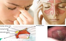 Viêm mũi xoang mùa mưa: Đừng chủ quan với những cơn nghẹt mũi kéo dài