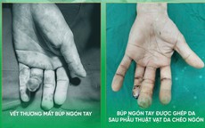 Thêm giải pháp tạo hình cho người bị khuyết hổng đầu ngón tay