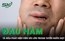 Đau hàm lâu ngày, người đàn ông tá hỏa phát hiện viên sỏi lớn trong tuyến nước bọt