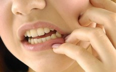 Viêm xương hàm hay bị bỏ qua do triệu chứng dễ nhầm với bệnh răng miệng thông thường
