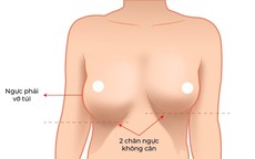 Vì sao xử lý túi ngực bị vỡ và đặt lại túi mới khó hơn nhiều so với nâng ngực lần đầu?