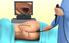 Trước và sau khi nội soi đại tràng cần lưu ý gì?