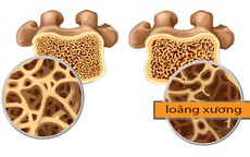 Thói quen tốt giúp phòng ngừa loãng xương sau mãn kinh