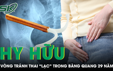 Vòng tránh thai 'mất tích' 29 năm bất ngờ được tìm thấy trong bàng quang