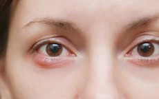 Ngứa rát, khô mắt kéo dài, cảnh giác với viêm bờ mi