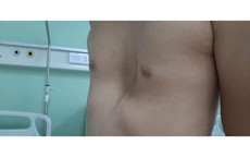 4 dấu hiệu phát hiện lõm ngực bẩm sinh ở trẻ