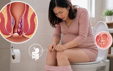 Mẹ bầu làm gì để giảm nguy cơ mắc bệnh trĩ?