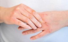 6 thói quen giúp kiểm soát viêm da cơ địa, giảm nguy cơ tái phát