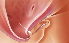 Lỗ tiểu thấp ở bé trai, có nên cắt bao quy đầu sớm?