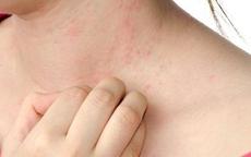 Ngứa, nổi mề đay có phải là triệu chứng sớm của bệnh gan?