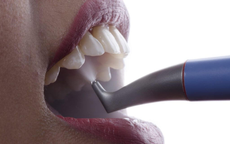 Lấy cao răng bằng hệ thống khí muối: phương pháp làm sạch răng hiệu quả