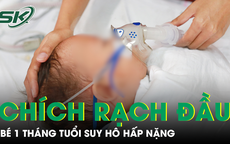 Bé 1 tháng tuổi suy hô hấp nặng vì đốt bấc và chích rạch đầu