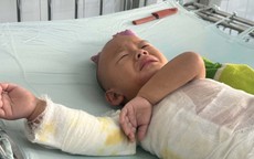 Bé trai dân tộc H’Mông 3 tuổi bị bỏng nặng cần sự giúp đỡ