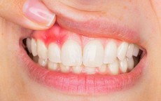 Viêm lợi sau khi bọc răng sứ phải làm gì?