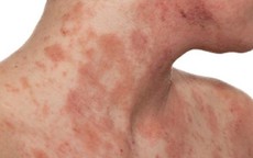 Phân biệt viêm da cơ địa với các bệnh da khác