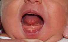 Dính thắng lưỡi ảnh hưởng thế nào đến trẻ?