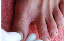 Bệnh ngoài da hay gặp mùa mưa bão