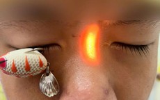 Móc câu xuyên thủng mắt, bé trai 13 tuổi nguy cơ ảnh hưởng thị lực lâu dài