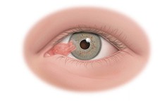7 dấu hiệu nhận biết xước, rách giác mạc