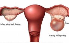 U nang buồng trứng ác tính có chữa được không?