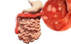 Viêm ruột có nguy hiểm không?
