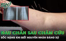 Đau chân dữ dội sau châm cứu, người phụ nữ sốc nặng khi biết nguyên nhân