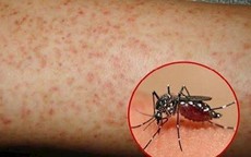 Cô gái tử vong vì sốt xuất huyết, cảnh báo không chủ quan biến chứng bệnh