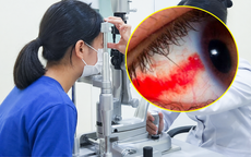 Bé gái 12 tuổi bị dây cáp quẹt vào mắt rách võng mạc