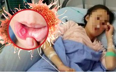 Cô gái 26 tuổi 'chết lặng' phát hiện ung thư giai đoạn 3 khi khám nhiệt miệng