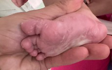 Bé gái 3 tháng tuổi mắc giang mai bẩm sinh
