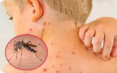 7 dấu hiệu cảnh báo sốt xuất huyết chuyển nặng sau khi hết sốt